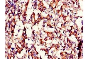 Immunohistochemistry of paraffin-embedded human gastric cancer using ABIN7159104 at dilution of 1:100 (MED12 antibody  (AA 1742-2011))