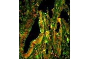 Immunofluorescence analysis of CZA1 Antibody (N-term) with paraffin-embedded human prostate carcinoma tissue.