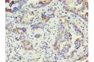Immunohistochemistry of paraffin-embedded human lung cancer using ABIN7157372 at dilution of 1:100 (Cytokeratin 1 antibody  (AA 1-584))