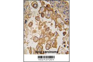 Formalin-fixed and paraffin-embedded human lung carcinoma tissue reacted with Mouse TLR6 antibody , which was peroxidase-conjugated to the secondary antibody, followed by DAB staining. (TLR6 antibody  (C-Term))