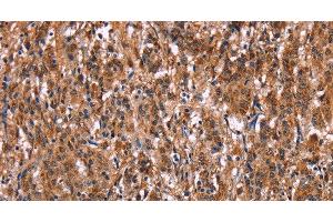 Immunohistochemistry of paraffin-embedded Human gasrtic cancer tissue using LILRB1 Polyclonal Antibody at dilution 1:50 (LILRB1 antibody)