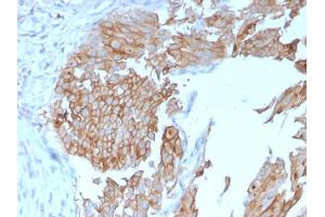 Formalin-fixed, paraffin-embedded human Urothelial Carcinoma stained with Uroplakin 1B Mouse Monoclonal Antibody (UPK1B/3102). (Uroplakin 1B antibody  (AA 109-229))