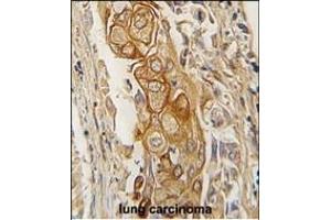 Formalin-fixed and paraffin-embedded human lung carcinoma tissue reacted with AC antibody (C-term) (ABIN391855 and ABIN2841687) , which was peroxidase-conjugated to the secondary antibody, followed by DAB staining. (ACPP antibody  (C-Term))