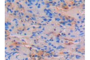 Detection of STAT4 in Human Lung Tissue using Polyclonal Antibody to Signal Transducer And Activator Of Transcription 4 (STAT4) (STAT4 antibody  (AA 505-737))