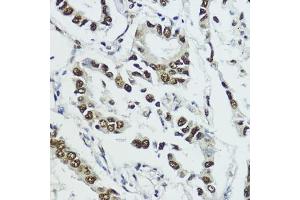Immunohistochemistry of paraffin-embedded human lung cancer using Phospho-Histone H3-T11 antibody (ABIN3023615, ABIN3023616, ABIN3023617 and ABIN6225469) at dilution of 1:100 (40x lens). (Histone 3 antibody  (pThr11))