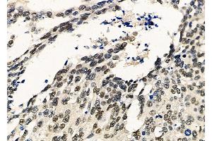 ABIN6259614 and ABIN6275390 at 1/100 staining Human ovarian cancer by IHC-P.
