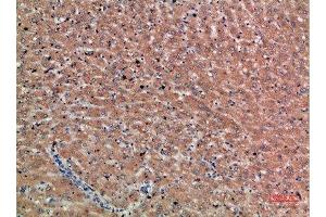 Immunohistochemical analysis of paraffin-embedded human-liver-cancer, antibody was diluted at 1:200 (Chordin antibody  (AA 905-954))