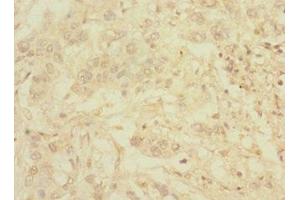 Immunohistochemistry of paraffin-embedded human pancreatic cancer using ABIN7174780 at dilution of 1:100 (C1ORF127 antibody  (AA 401-648))