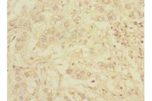 Immunohistochemistry of paraffin-embedded human pancreatic cancer using ABIN7174780 at dilution of 1:100