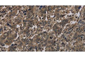 Immunohistochemistry of paraffin-embedded Human liver cancer using Histone H4 Polyclonal Antibody at dilution of 1:30 (Histone H4 antibody)