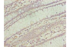 Immunohistochemistry of paraffin-embedded human colon cancer using ABIN7173167 at dilution of 1:100 (TMEM243 antibody  (AA 1-31))