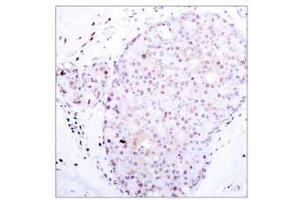 Immunohistochemical analysis of paraffin-embedded human breast carcinoma, using NF-κB p105/p50 (Ab-907) antibody (E021019). (NFKB1 antibody)