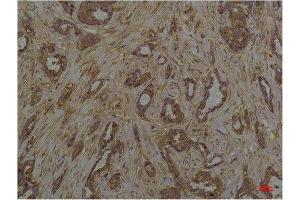 Immunohistochemistry (IHC) analysis of paraffin-embedded Human Breast Caricnoma using Phosphoserine Mouse mAb diluted at 1:200. (Phosphoserine antibody  (phosphorylated))