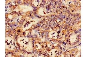 Immunohistochemistry of paraffin-embedded human liver cancer using ABIN7146988 at dilution of 1:100 (CTNND1 antibody  (AA 482-605))