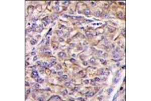 Formalin-fixed and paraffin-embedded human hepatocarcinoma tissue reacted with TAOK3 antibody (C-term), which was peroxidase-conjugated to the secondary antibody, followed by DAB staining. (TAO Kinase 3 antibody  (C-Term))