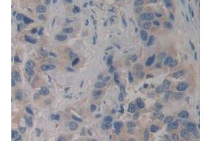Detection of PIK3C3 in Human Breast cancer Tissue using Polyclonal Antibody to Phosphoinositide-3-Kinase Class 3 (PIK3C3) (PIK3C3 antibody  (AA 631-885))