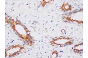 Immunohistochemical analysis of paraffin-embedded cancer sections, staining PP2A in cytoplasm, DAB chromogenic reaction