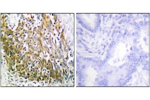 Iunohistochemistry analysis of paraffin-embedded human lung carcinoma tissue using P-10 antibody. (MMP10 antibody)