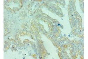 Immunohistochemistry of paraffin-embedded human bladder cancer using ABIN7145824 at dilution of 1:100 (BRD9 antibody  (AA 338-597))
