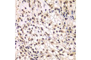 Immunohistochemistry of paraffin-embedded human kidney cancer using SMARCC1 antibody at dilution of 1:200 (400x lens). (SMARCC1 antibody)