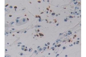 Detection of DEFa4 in Human Stomach cancer Tissue using Polyclonal Antibody to Defensin Alpha 4, Corticostatin (DEFa4) (DEFA4 antibody  (AA 23-97))