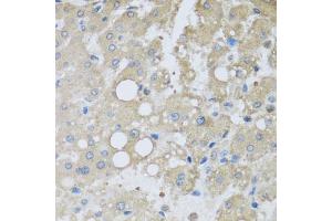 Immunohistochemistry of paraffin-embedded human liver injury using CHMP1B antibody (ABIN5974811) at dilution of 1/100 (40x lens). (CHMP1B antibody)