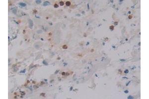 Detection of DEFa4 in Human Breast cancer Tissue using Polyclonal Antibody to Defensin Alpha 4, Corticostatin (DEFa4) (DEFA4 antibody  (AA 23-97))