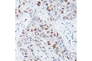 Immunohistochemistry of paraffin-embedded human lung squamous carcinoma tissue using RBPJK Rabbit mAb (ABIN1682563, ABIN3018511, ABIN3018512 and ABIN7101620) at dilution of 1:50 (40x lens). (RBPJ antibody)