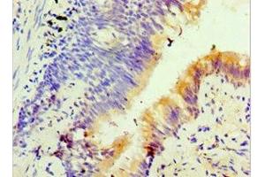 Immunohistochemistry of paraffin-embedded human lung cancer using ABIN7153127 at dilution of 1:100 (FOSL2 antibody  (AA 187-326))