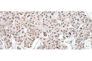 Immunohistochemistry of paraffin-embedded Human prost ate cancer tissue using HNRNPH2 Polyclonal Antibody at dilution of 1:40(x200) (HNRNPH2 antibody)