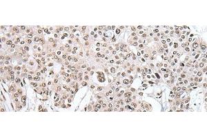 Immunohistochemistry of paraffin-embedded Human prost ate cancer tissue using HNRNPH2 Polyclonal Antibody at dilution of 1:40(x200) (HNRNPH2 antibody)