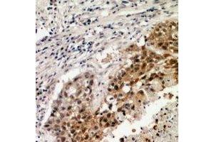 Immunohistochemical analysis of VEGFR3 staining in human lung formalin fixed paraffin embedded tissue section. (FLT4 antibody)