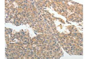 The image on the left is immunohistochemistry of paraffin-embedded Human liver cancer tissue using ABIN7189581(ABCB11 Antibody) at dilution 1/25, on the right is treated with synthetic peptide. (ABCB11 antibody)