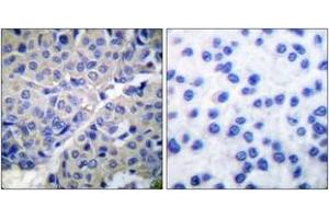 Immunohistochemistry analysis of paraffin-embedded human breast carcinoma, using Synaptotagmin (Phospho-Ser309) Antibody. (Synaptotagmin antibody  (pSer309))