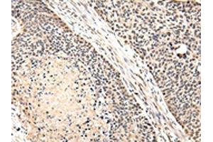 The image on the left is immunohistochemistry of paraffin-embedded Human esophagus cancer tissue using ABIN7131587(VPS41 Antibody) at dilution 1/20, on the right is treated with fusion protein.