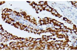 Immunohistochemistry of paraffin-embedded Human thyroid cancer using IDH3A Polyclonal Antibody at dilution of 1:100 (40x lens).