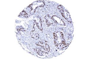 Colorectal adenocarcinoma with a large fraction of MCM7 positive tumor cells (Recombinant MCM7 antibody  (AA 195-319))