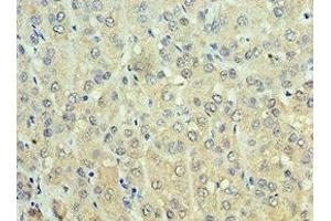 Immunohistochemistry of paraffin-embedded human liver cancer using ABIN7143649 at dilution of 1:100 (ADH1C antibody  (AA 1-375))