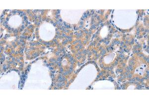Immunohistochemistry of paraffin-embedded Human thyroid cancer using SLC25A13 Polyclonal Antibody at dilution of 1:35 (slc25a13 antibody)