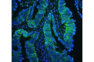 IF analysis of CD147/Emmprin using anti-CD147/Emmprin antibody (ABIN5518743) CD147/Emmprin was detected in paraffin-embedded section of human intestinal cancer tissues. (CD147 antibody  (AA 138-323))