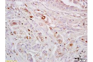 Formalin-fixed and paraffin embedded human lung carcinoma labeled with Rabbit Anti EPH receptor A4 Polyclonal Antibody, Unconjugated (ABIN734123) at 1:200 followed by conjugation to the secondary antibody and DAB staining (EPH Receptor A4 antibody  (AA 531-630))