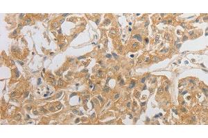 Immunohistochemistry of paraffin-embedded Human lung cancer tissue using HCRTR2 Polyclonal Antibody at dilution 1:50 (HCRTR2 antibody)