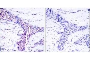 Immunohistochemistry analysis of paraffin-embedded human breast carcinoma tissue, using ATF2 (Ab-73 or 55) Antibody. (ATF2 antibody  (AA 40-89))