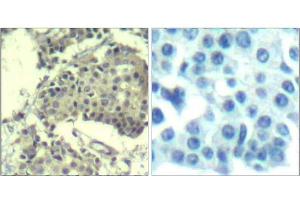 Immunohistochemical analysis of paraffin-embedded human breast carcinoma tissue using mTOR (Ab-2481) Antibody (E021515). (MTOR antibody)