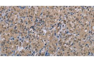Immunohistochemistry of paraffin-embedded Human thyroid cancer tissue using MGLL Polyclonal Antibody at dilution 1:40 (MGLL antibody)