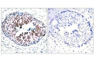 Immunohistochemical analysis of paraffin-embedded human breast carcinoma tissue using STAT5A(Phospho-Ser780) Antibody(left) or the same antibody preincubated with blocking peptide(right). (STAT5A antibody  (pSer780))