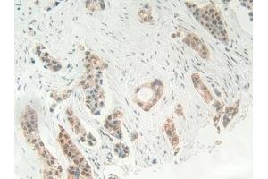 Detection of HMGB1 in Human Breast cancer Tissue using Polyclonal Antibody to High Mobility Group Protein 1 (HMGB1) (HMGB1 antibody  (AA 1-215))