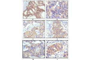 Immunohistochemical analysis of paraffin-embedded human breast intraductal carcinama tissue(A) and breast infiltrating ductal carcinama tissue(B) showing membrane localization using HER-2 antibody with DAB staining. (ErbB2/Her2 antibody)