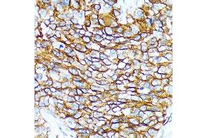 Immunohistochemistry of paraffin-embedded human oophoroma using CD239/BCAM Rabbit mAb (ABIN7265828) at dilution of 1:100 (40x lens). (BCAM antibody)