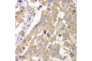 Immunohistochemistry of paraffin-embedded human esophageal cancer using PFKM antibody at dilution of 1:100 (x40 lens). (PFKM antibody)